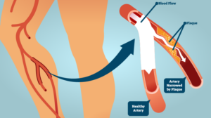 Peripheral Artery Disease – What Is It and How Can I Prevent It? 1