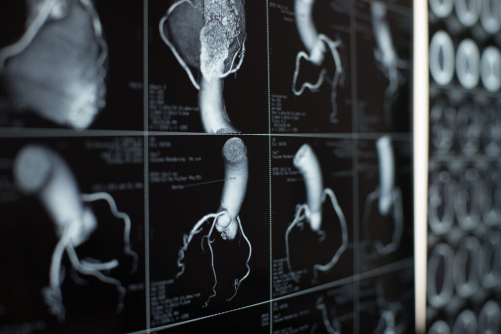 Section Spotlight – Cardiovascular and Thoracic Imaging - TRA Endovascular