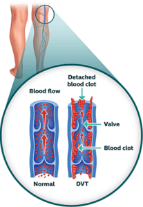 The ABCs of Vascular Disease 3