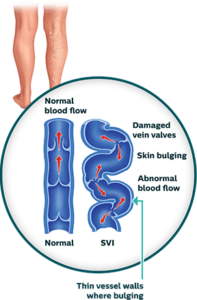 The ABCs of Vascular Disease 4