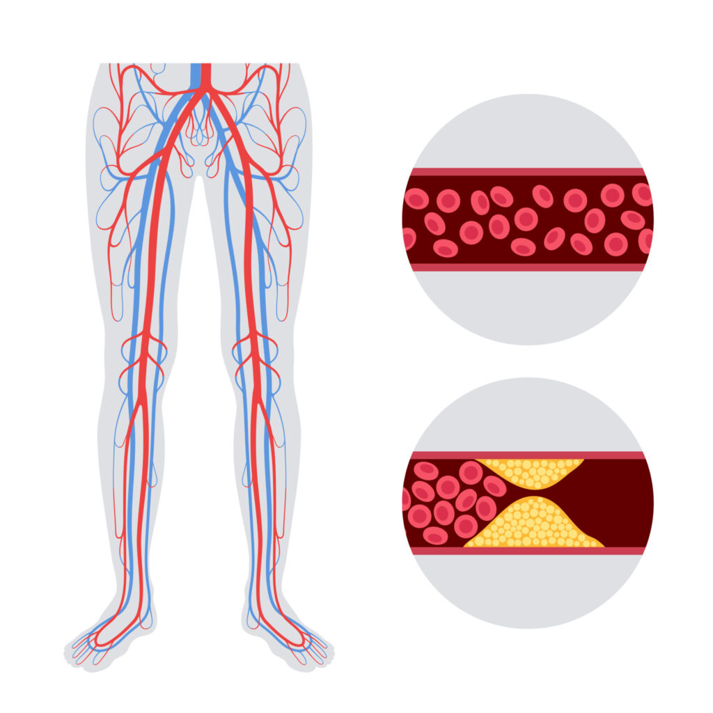 Peripheral Artery Disease Awareness Month TRA Endovascular