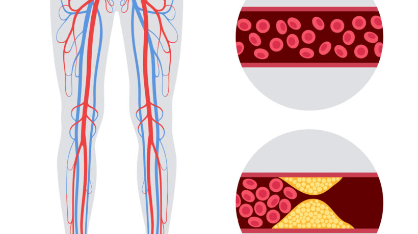 Peripheral Artery Disease Awareness Month