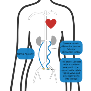 Pelvic Venous Disorders (PeVD) 1