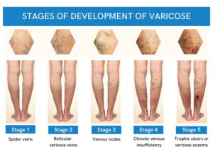 Varicose Veins & Spider Veins