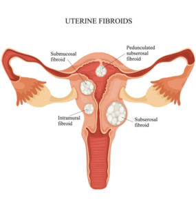 Uterine Fibroids and Adenomyosis 1