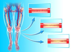 Critical Limb Ischemia