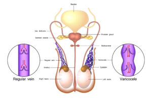 Varicocele