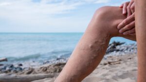 Transform Your Life: Discover Revolutionary Varicose and Spider Vein Treatments at TRA Endovascular