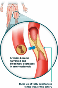 Tired Legs or Something More? How to Tell if It’s Peripheral Artery Disease (PAD)